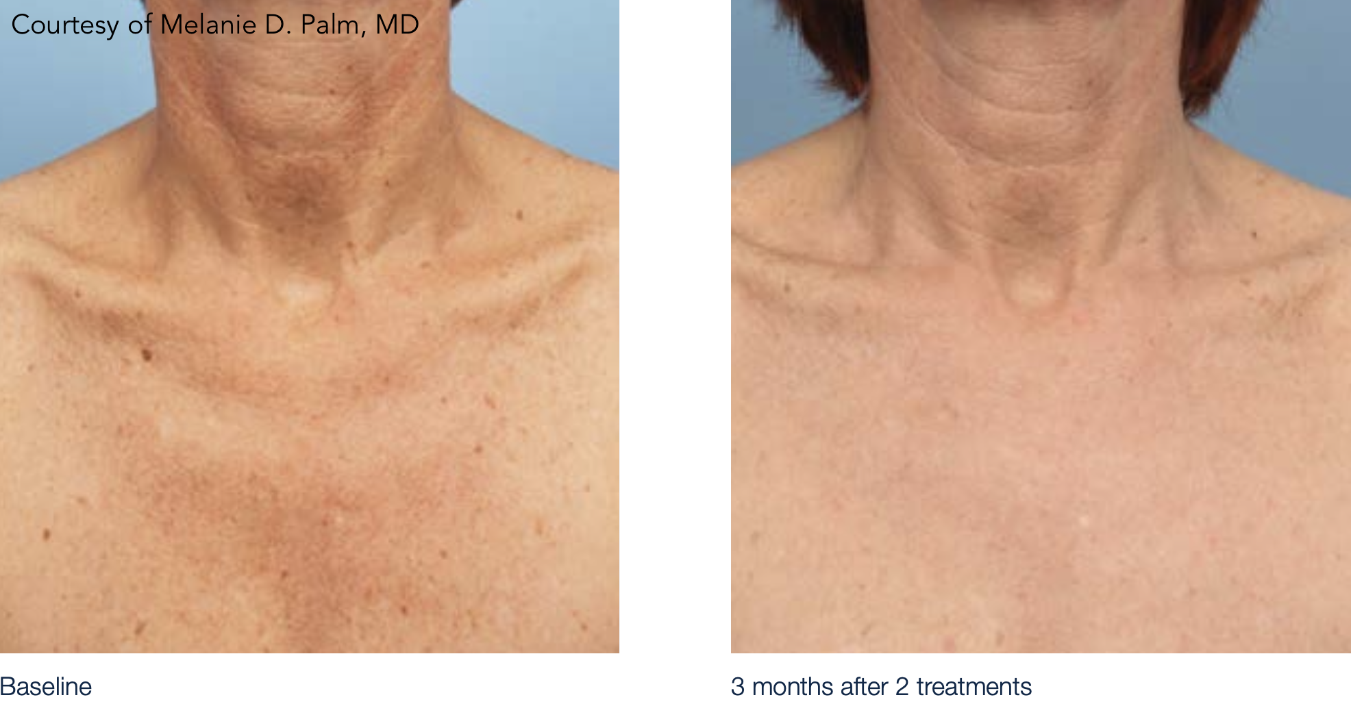 M22 IPL freckles chest poikiloderma neck laser before after