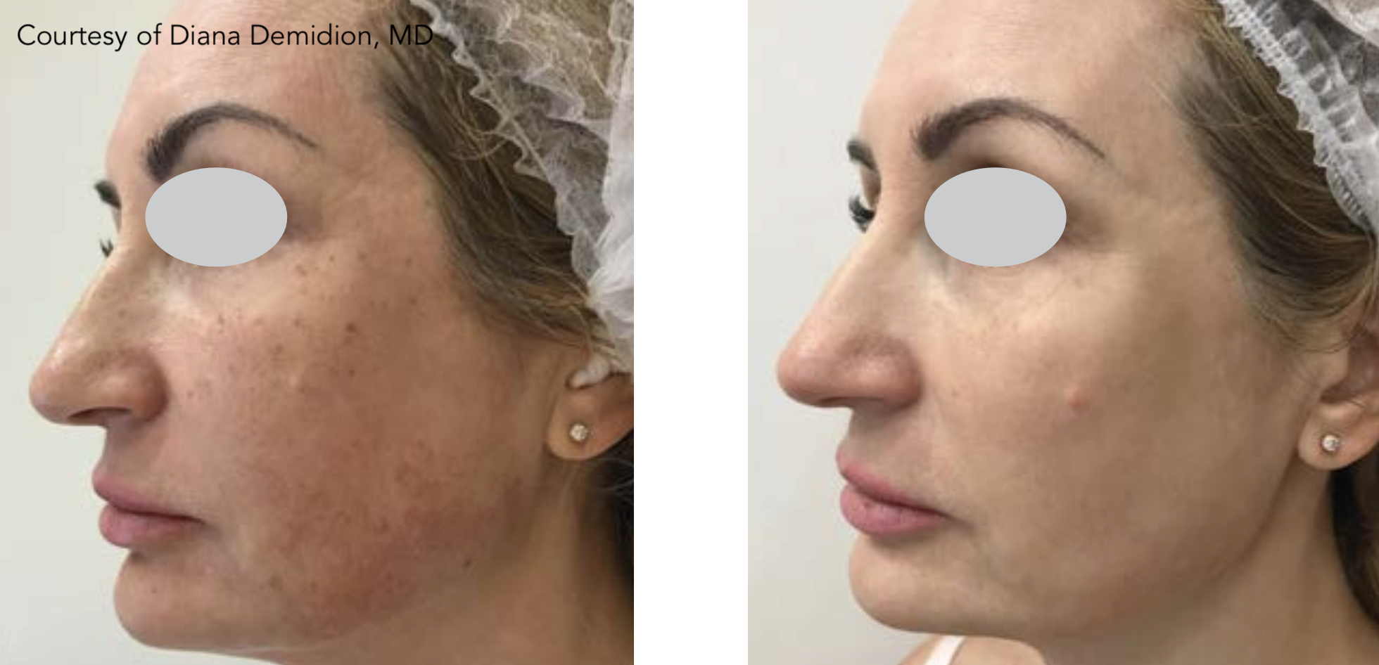 M22 IPL ResurFX face photofractional laser before after
