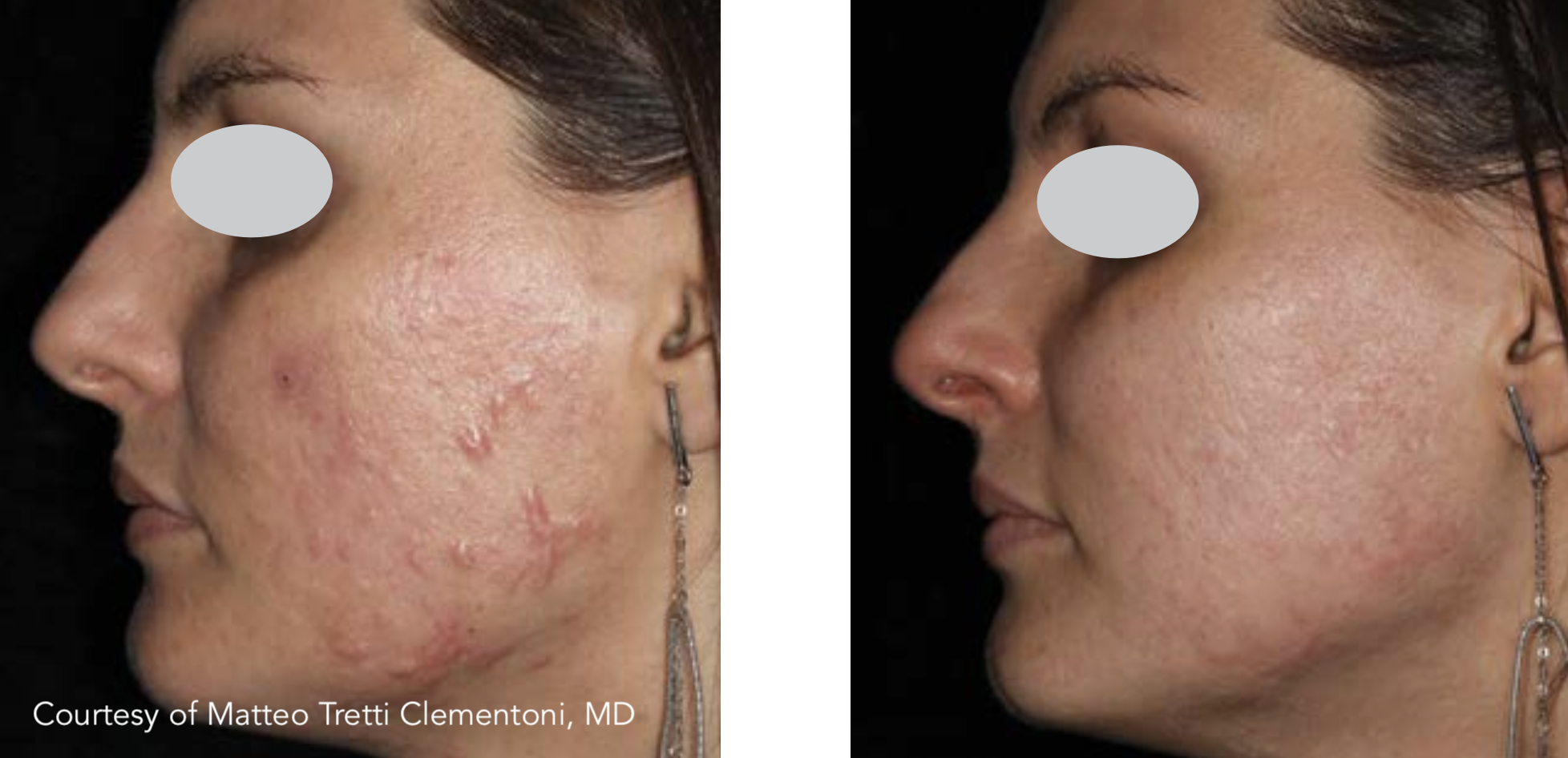 M22 ResurFX laser fractional non-ablative acne scars face before after