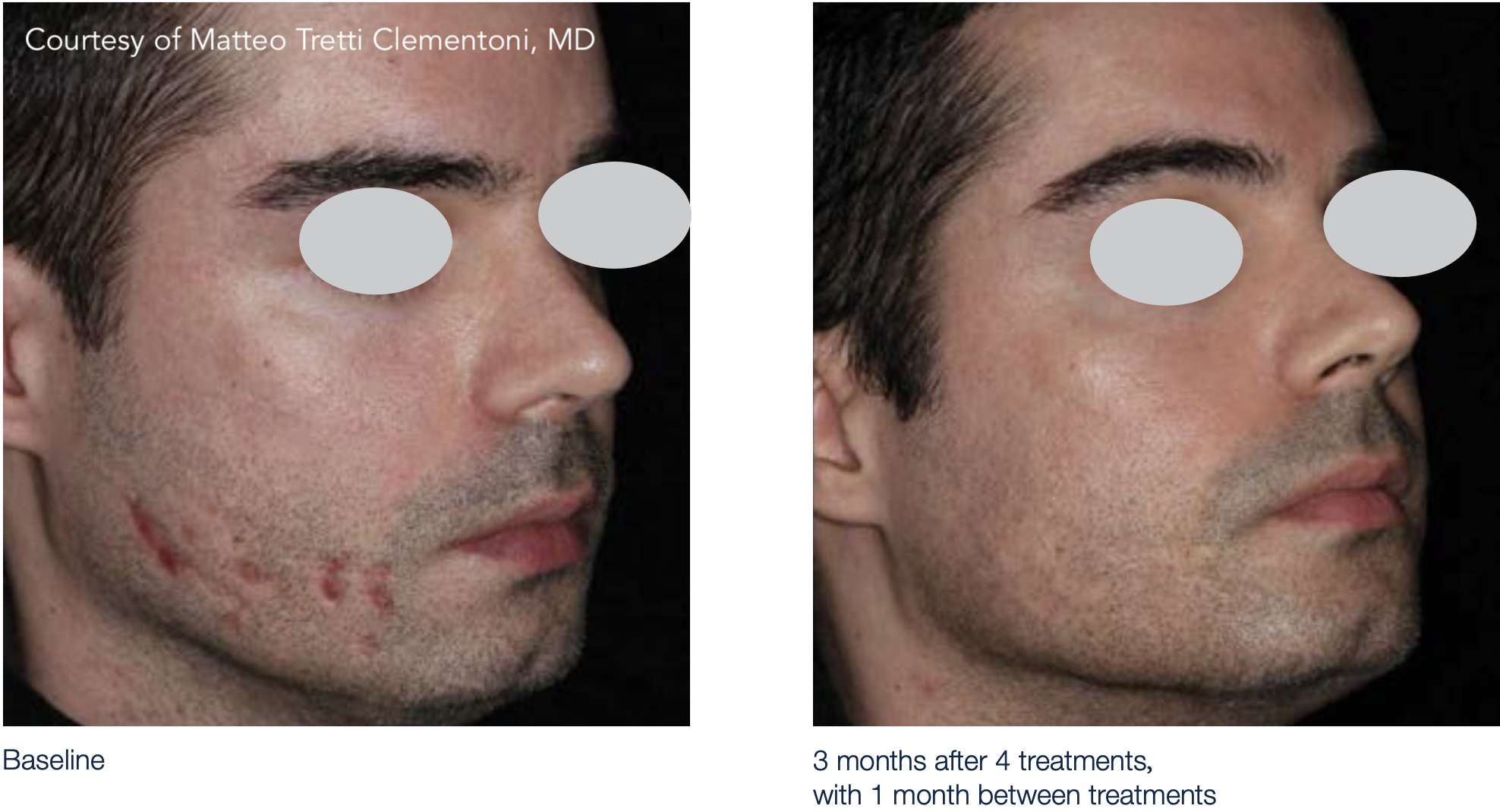 M22 ResurFX laser fractional non-ablative acne scars face before after